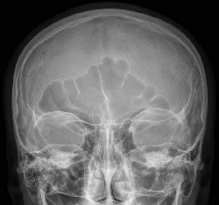 X-ray of the sinuses of the nose