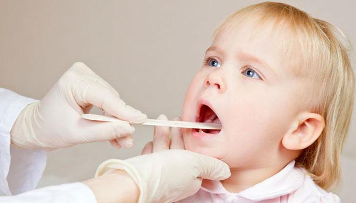 sintomi di tonsillite cronica e trattamento nei bambini