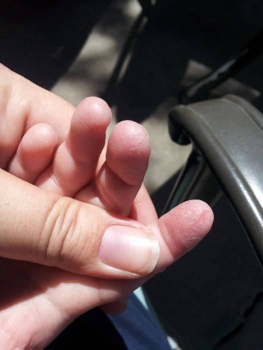 la piel del niño en los dedos