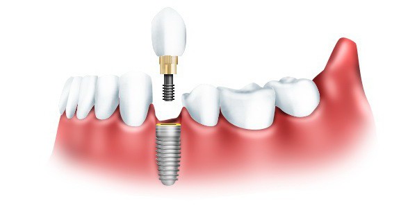 soorten tandheelkundige implantaten