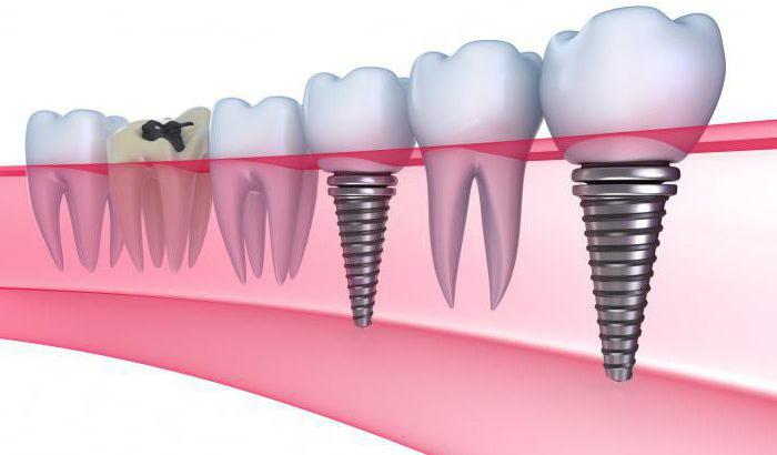  soorten tandheelkundige implantaten van verschillende fabrikanten